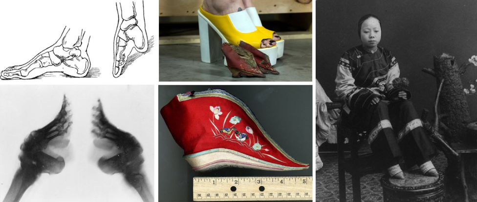 Результаты китайской практики бинтования